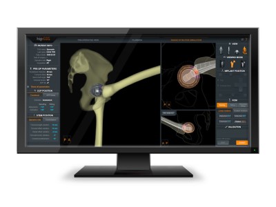 3D Surgical Planning – EOS IMAGING